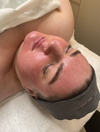 woman immediately after getting Moxi Laser Treatment